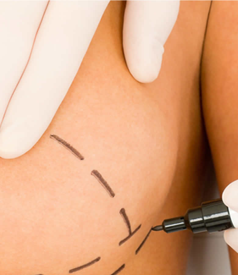 Mamoplastia Redutora